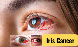  iris melanoma