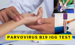 parvovirus b19 igg