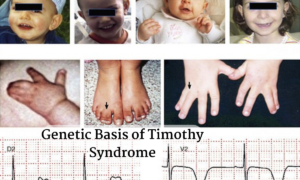 timothy syndrome