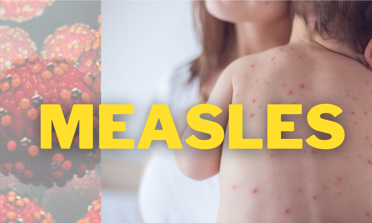 measles outbreak