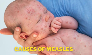 measles outbreak 