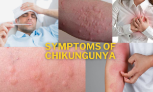  Chikungunya Virus