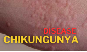  Chikungunya Virus