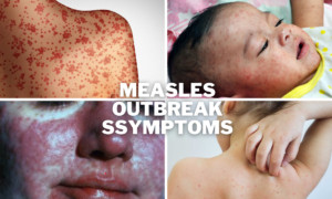 measles outbreak 