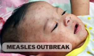 measles outbreak 