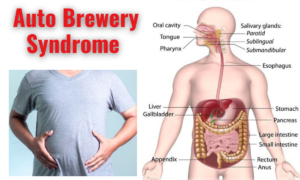 auto brewery syndrome