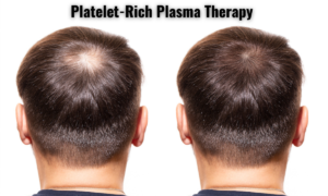 prp for hair growth