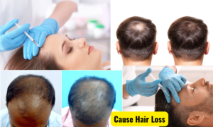 prp for hair growth