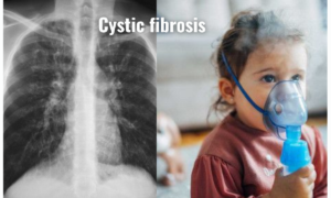 cystic fibrosis supportive therapy