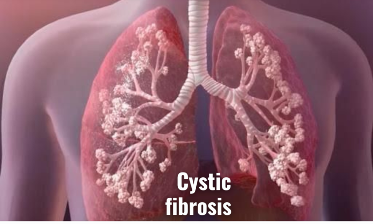 cystic fibrosis supportive therapy