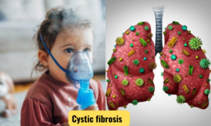 cystic fibrosis supportive therapy