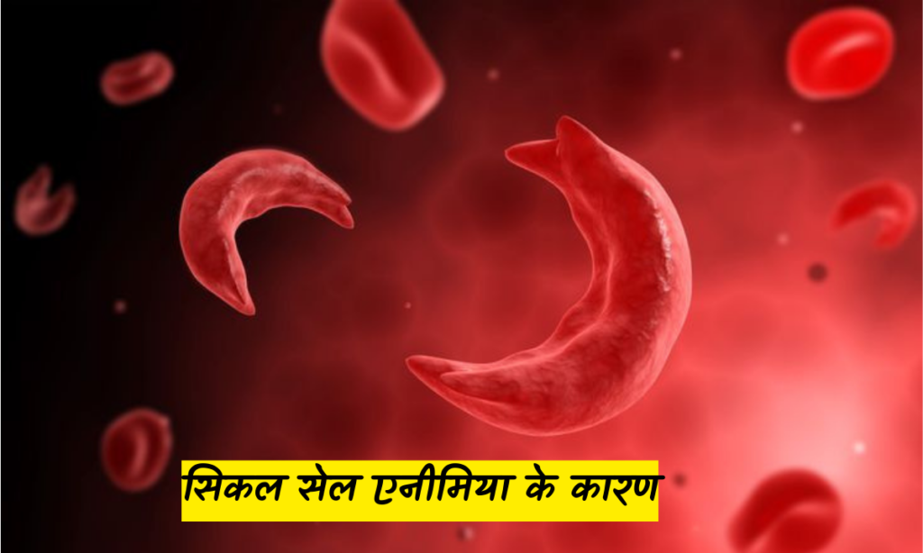 Sickle Cell Anemia